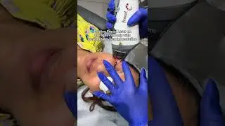 Fraxel Laser for Hyperpigmentation, Fine Lines & Texture | Derm Explains
