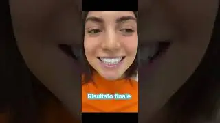 Sbiancamento dentale Centro dentistico Santa Chiara