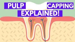 Direct and Indirect Pulp Capping (Vital Pulp Therapy)  - Explained in Detail