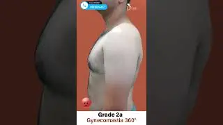 Grade 2A Gynecomastia Surgery 360&deg; Before After Results #shortsfeed