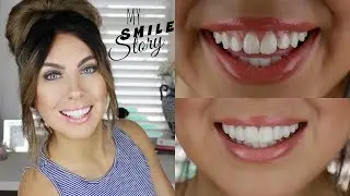 true smile veneers
