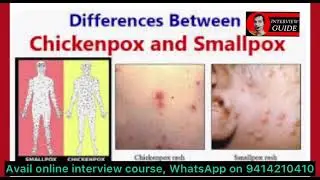 Smallpox vs Chickenpox | AMC Doctor interview questions | Army medical corps | Interview Guide