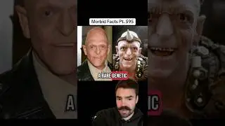 У него редкое заболевание, которое с ним ЧТО делает?! #болезненныефакты