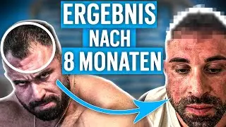 Meine Haartransplantation! Das Zwischenergebnis nach 8 Monaten!