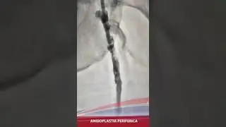 Oclusion total de arteria femoral superficial en paciente con isquemia crítica.