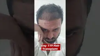 Hair Transplant 3 month 29 day result  #hairlinetransplant #dhihairtransplant