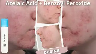 AD 30 Days Of...DERMATICA | Azelaic Acid & Benzoyl Peroxide | 1 MONTH REVIEW