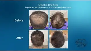 Hair Transplant Black Market Corrective Case Study from Athens | Dr. Giorgios Zontos Repair