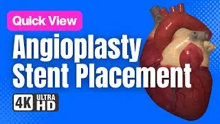 Angioplasty and Stent Placement // See How It Works // 3D Animation
