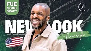 Shodel's 10/10 Experience Hair Transplant Experience | Full Review at Heva Clinic #afrohair