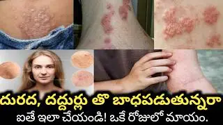 How To Stop Itching Skin |durada daddurlu thaggalante emi cheyali|dhuradhalu thaggalante emi cheyali
