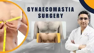 Gynecomastia Surgery: How to Get Rid of Male Chest Fat - Results & More