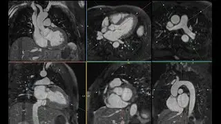 KIS &ndash; Prof. Robert R. Edelman &ndash; T1RESS: novel Bright & Dark Blood Imaging of the Heart and Lungs