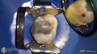 Ultrasonic role in Endodontics and review of UltraMint Pro from Eighteeth by Marino Sutedjo