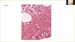 Case (4G):Fundic gland polyp