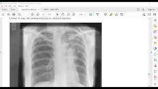 #MRCP   PART TWO #PASTEST 2020 RESPIRATORY 19