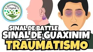 SINAL DE GUAXINIM - FRATURA DE BASE DO CRÂNIO - TCE