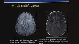 TMT: MRI in Pediatric White Matter Diseases - IV, by Dr Deepak Patkar
