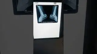 X-ray image of the heel highlighting a heel spur on the calcaneus bone #anklefusion #tendinopathies