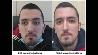 Iskustvo pacijenta nakon estetske operacije strabizma u specijalnoj bolnici Sveti Vid