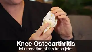 What is Knee Osteoarthritis