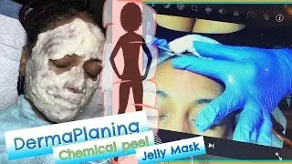 Curing acne with anit-aging Facials - Dermaplaning Part 1