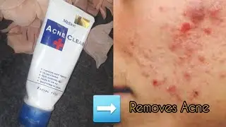 Mistine Acne Clear Facewash Review |Facial Foam for acne scars