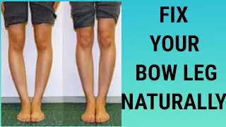 Bow legs no more review | looking for a permanent remedy for bow legs without the need for surgery