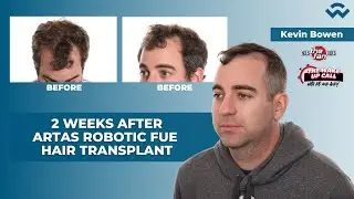 ARTAS Robotic FUE Hair Transplant | 2 Weeks Later with Kevin Bowen