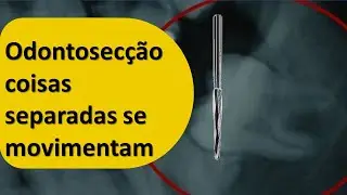 Odontosec&ccedil;&atilde;o, coisas separadas se movimentam | Odontologia | Dra Bianca Rosa