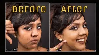 &hearts;How to Cover Acne Spots | Dark Spots | Pigmentation | Discoloration + My Foundation Routine&hearts;