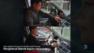 Peripheral Nerve Injury Recovery After Trauma
