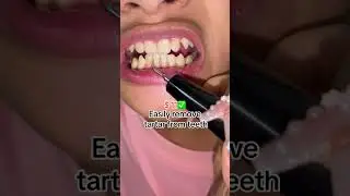 Clean family teeth with ultrasonic tooth cleaner! #oralhygiene