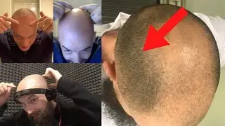 Bald Men Discuss 