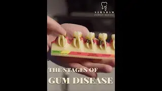 The stages of gum disease #gumdisease #gumbleeding #teeth #dental #dentalcare #brisbane #oralhealth