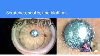 Replace Your GP Lenses and Retainers Yearly!