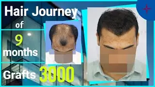 Hair Transplantation Result in 9 Months, 3000 Grafts, Grade 6 @Eugenix  by Drs Sethi & Bansal