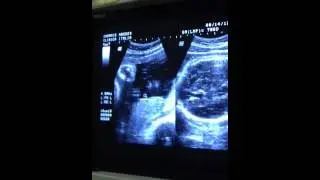 Baby Mielle Cassandra Abedes - Badajos (baby mica) @ 34 wee
