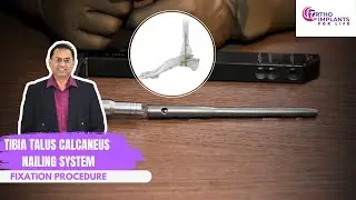 Tibia Talus Calcaneus Nailing System | TTC Nail Fixation Procedure