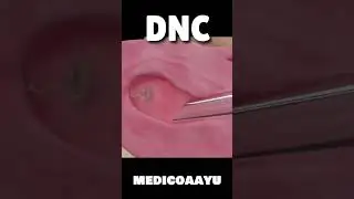 DNC PROCESS #shorts #shortsvideo #youtubeshorts #trending #viral #trend #DNC