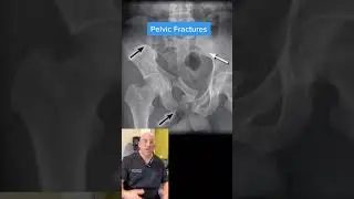 Toughest Surgery #orthopedicsurgery #fractures #trauma #nashville