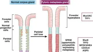 Mechanism of Metaplasia ; How cells undergo metaplasia