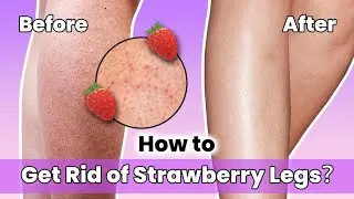 How to Get Rid of Strawberry Legs？#Skincare #Strawberryskin #rxmoore