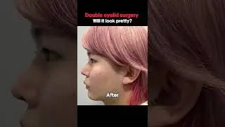 Is this possible? Before and after double eyelid surgery!