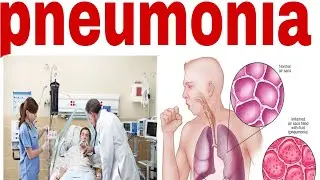 Pneumonia 