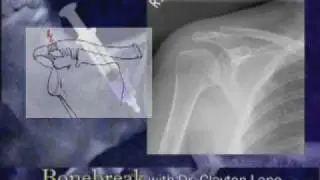 AC arthritis