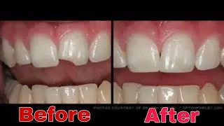 Porcelain Jacket Crown- Tooth preparation and porcelain build-up
