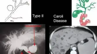 14 CASE REVIEW CT MRI   hepatic ,biliary ,GB
