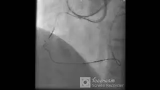 Retrograde CTO PCI of RCA, guide liner assisted retrograde reentry.