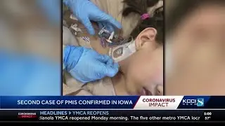 PMIS confirmed in two Iowa children